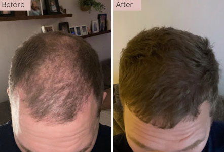 hair transplant before and afters